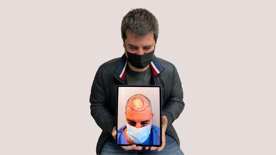 Sampayo: &quot;En un 99% de los casos, los genes son los causantes de la alopecia&quot;